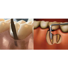 PDT - Micro-serrated periotomes