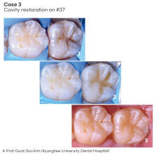 SPIDENT - EsCom 250 Light-cured restorative hybrid composite resin - Syringe Kit