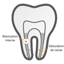 ANGELUS - BIO-C®SEALER Ciment d'obturation biocéramique (4 x 0.5g + 20 embouts)