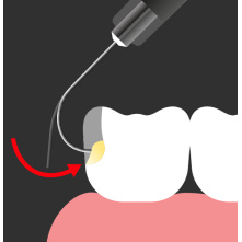 SPIDENT- Composite injectable EsFlowPlus - 2 seringues de 2,5g