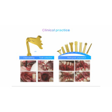 Woodpecker surgery x piezo motor WAM Woodpecker surgery x piezo motor WAM