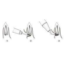 DTE WOODPECKER - Kit Apical Surgery - DTE® or SATELEC® compatibility ED19D ED20D ED23D ED21LD ED21RD