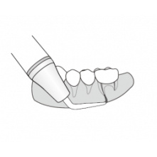 DTE WOODPECKER - Kit Apical Surgery - DTE® or SATELEC® compatibility ED19D ED20D ED23D ED21LD ED21RD