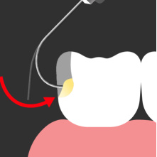 SPIDENT- Composite injectable EsFlowPlus - 2 seringues de 2,5g