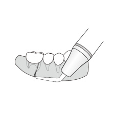 ED25LD Insert à ultrasons de chirurgie endodontique