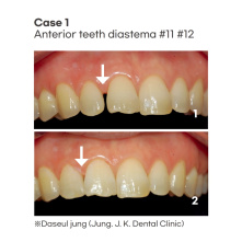 SPIDENT - EsCom 250 Light-cured restorative hybrid composite resin