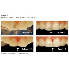 SPIDENT - EsCom 250 Light-cured restorative hybrid composite resin