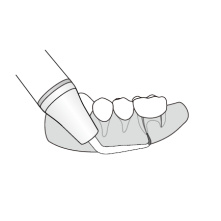 Woodpecker insert ED25RD