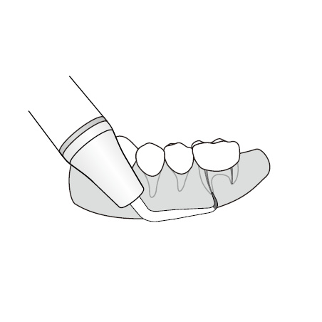 Woodpecker insert ED25RD
