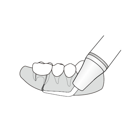 DTE WOODPECKER - Tip ED25LD